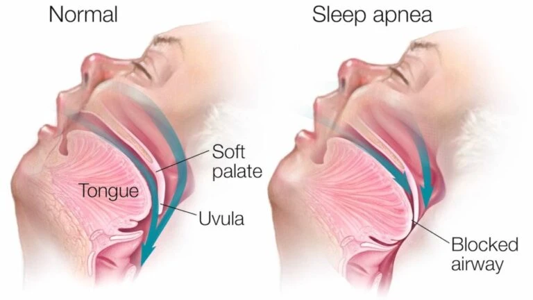 What Is The Link Between Snoring And Sleep Apnea In Franklin Square, Ny? 2 What is the link between snoring and sleep apnea in franklin square, ny